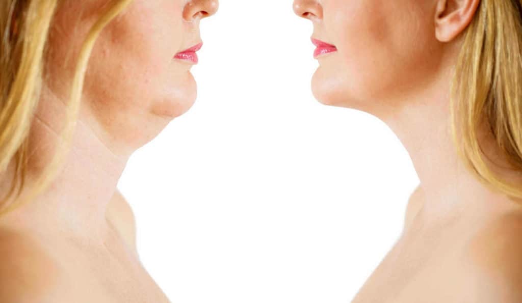 Double Chin treatment Sedgley before and after results