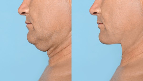 Which Non-Surgical Treatments Work Best for Jowls and Loose Skin Sedgley?