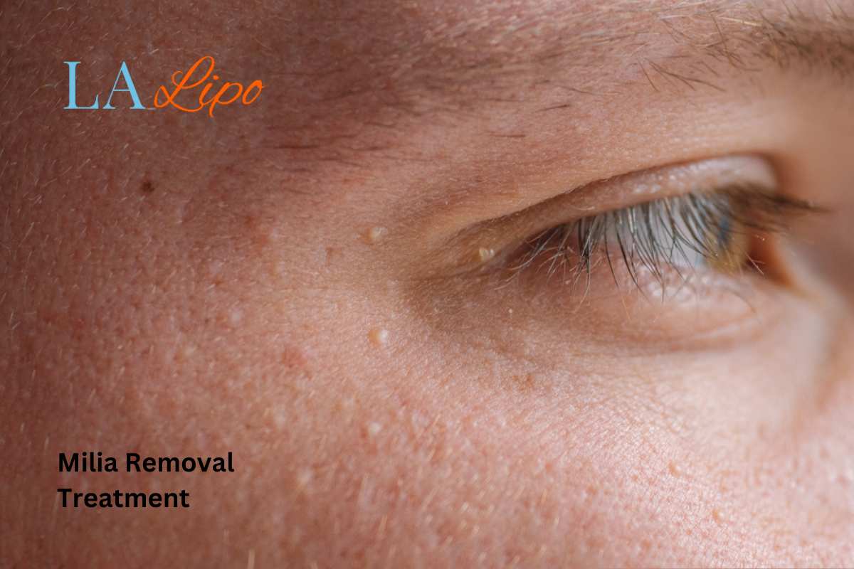Cryopen Milia Removal: Is It the Easiest and Safest Option Sedgley?