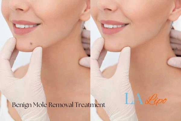 woman's before and after mole removal Sedgley results