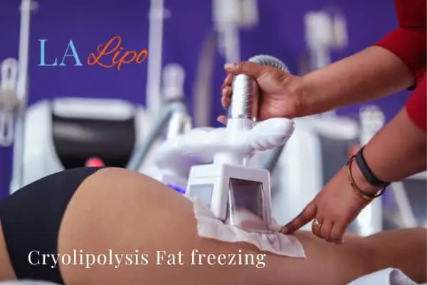 women getting fat freezing Sedgley