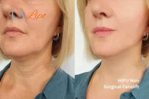 hi-fu for wrinkles Sedgley before and after results