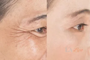 Before and after results of woman - HI-fu wrinkles reduction treatment Sedgley