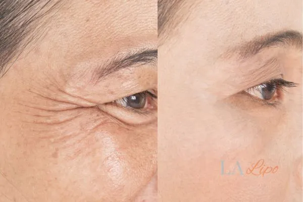 Before and after results of woman - HI-fu wrinkles reduction treatment Sedgley
