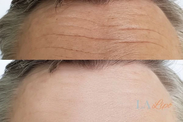 results of HIFU Sedgley on mans forehead to help reduce lines and wrinkles