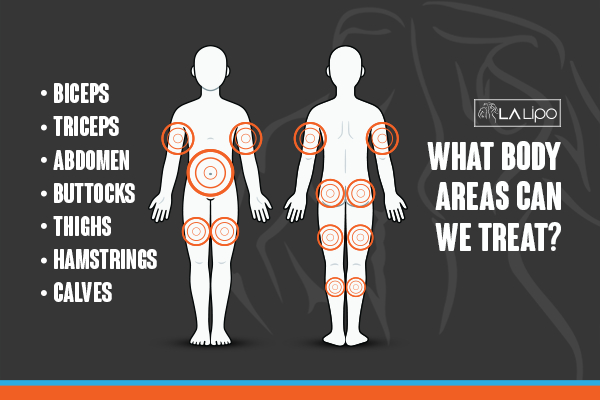 Graphic to show areas you can have LA-EMS Body Sculpting Sedgley treatment.
