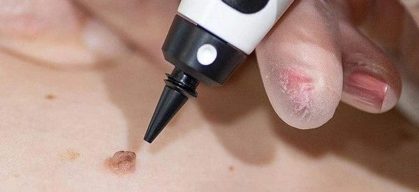 skin tag removal using cryopen Sedgley
