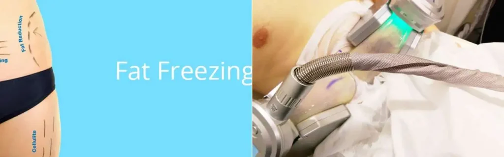 Fat freezing Sedgley on multiple areas of the body