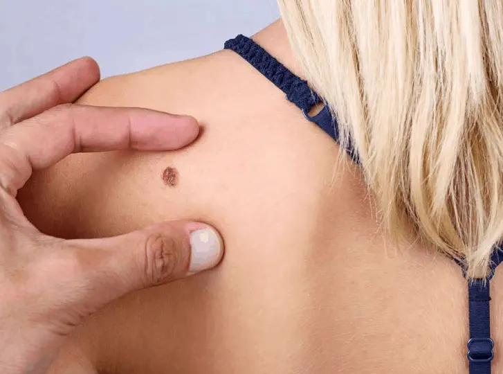woman having mole removal Sedgley consultation before treatment.