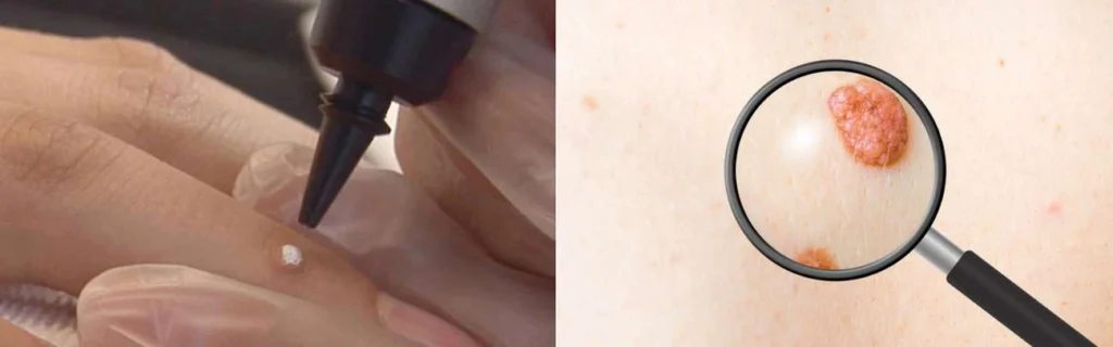 CryoPen practitioner Sedgley assessing a benign mole before treatment