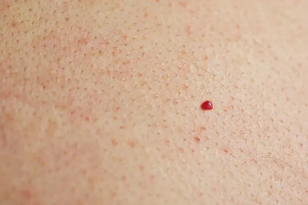 close up of a cherry angioma Sedgley