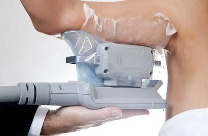 Picture of fat freezing Sedgley on the upper arms.