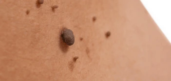 image of a skin tag Sedgley