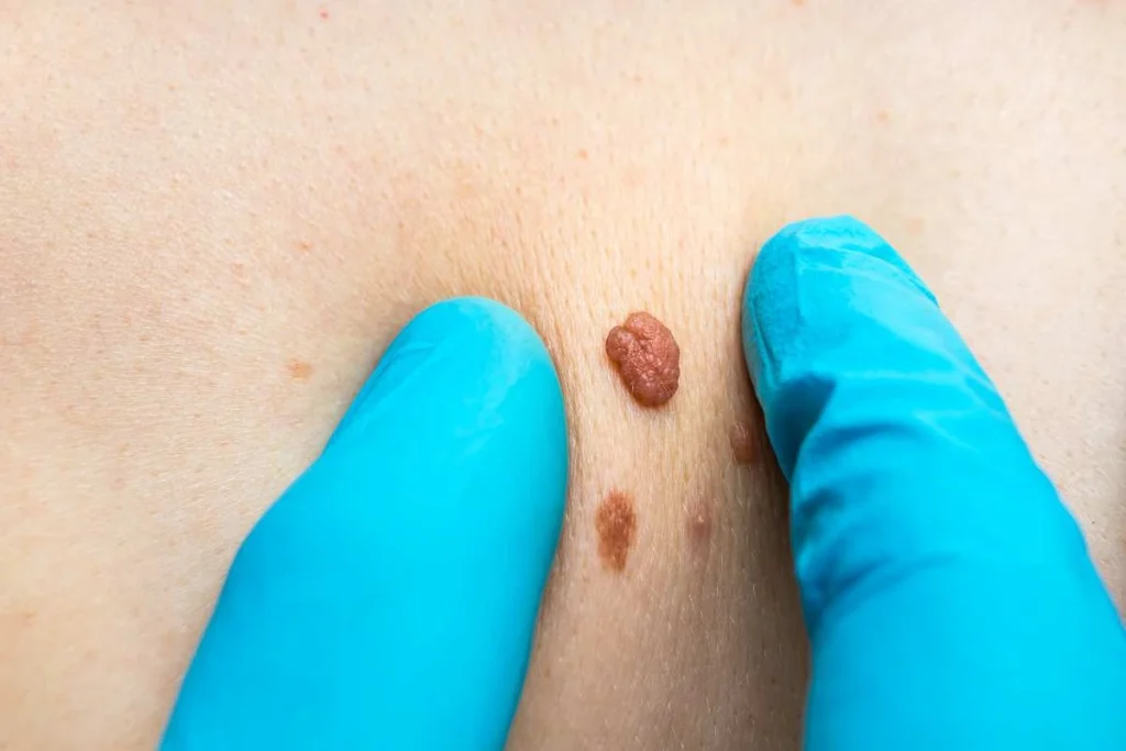 Consultant examining a skin tag Sedgley