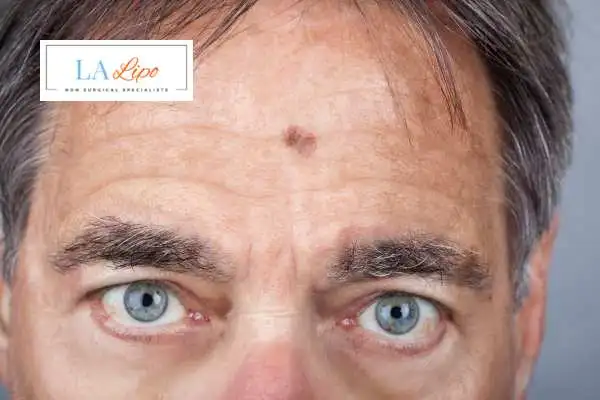 Solar Lentigo Removal Sedgley image of man with mark on his forehead