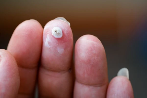 wart on person finger - cryotherapy to treat from LA LIPO Sedgley