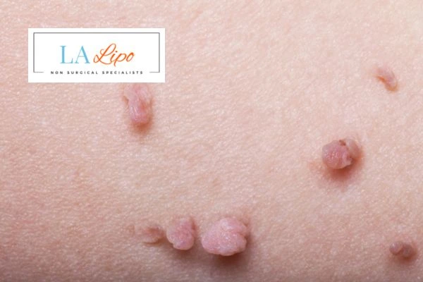Does cryopen skin tag removal Sedgley hurt? Find out now call our team today!