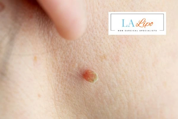 Book skin tag removal Sedgley today speak to our team now!