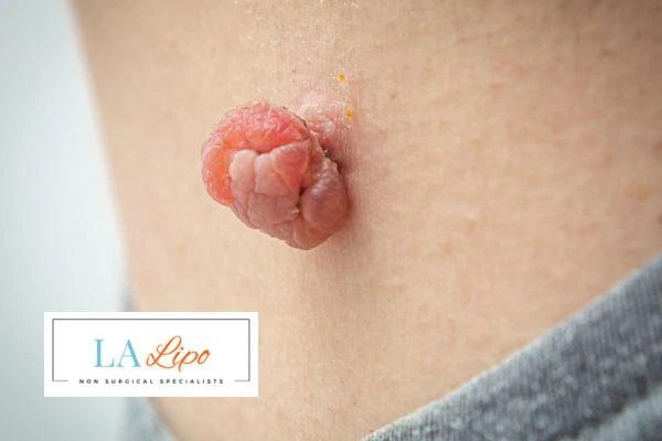 Interested in skin tag removal Sedgley? Concerned about the pain? Find out more today!