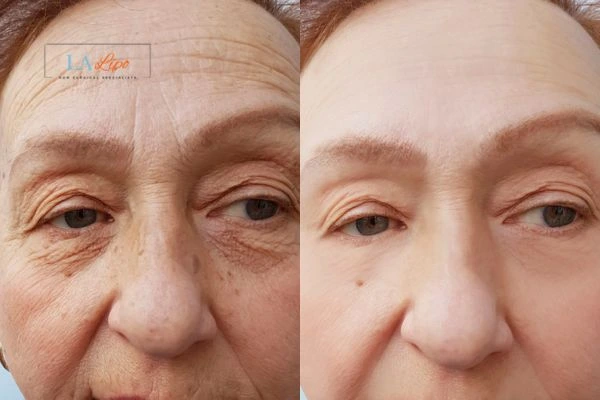 The powerful benefits of Morpheus8 Treatment Sedgley - Call Our team today!