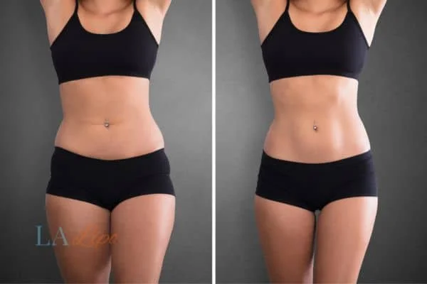 before and after results of non-surgical treatment to help a woman's body image and mental health Sedgley