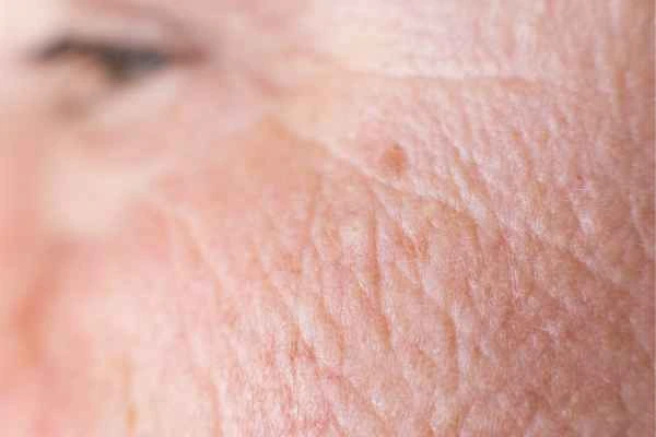close up picture of a woman's face showing an age spot Sedgley