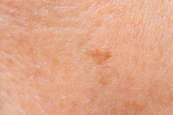 close up picture of age spots Sedgley