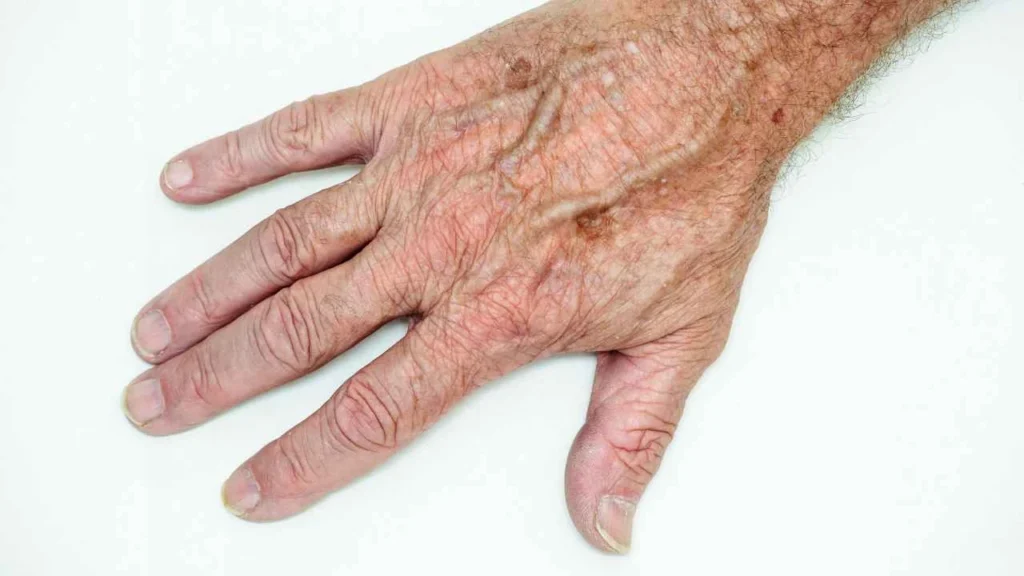 Male hand showing age spot Sedgley