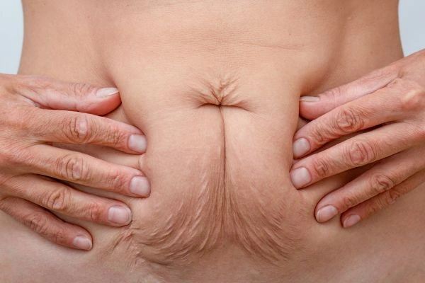 Should I Combine Diastasis Recti Treatment with Body Contouring for Better Results Sedgley?