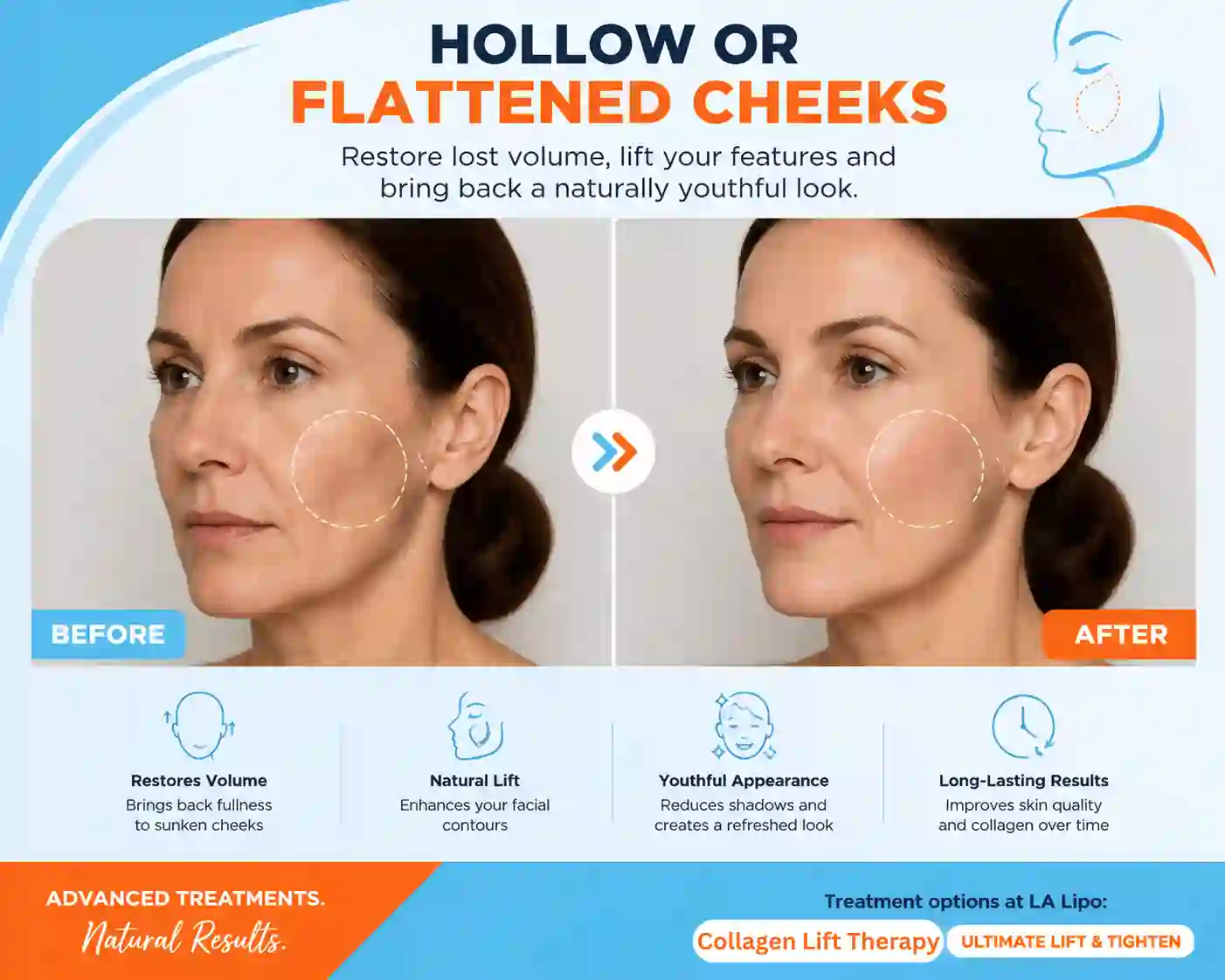 Sign #4: Hollow or Flattened Cheeks Sedgley