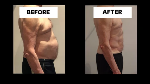 What Symptoms Can Diastasis Recti Cause in Men? Weak Core, Back Pain and Poor Posture Sedgley